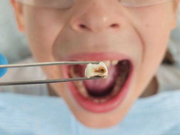 Best Emergency Dentist for Knocked-Out Tooth in Westlake Village, CA